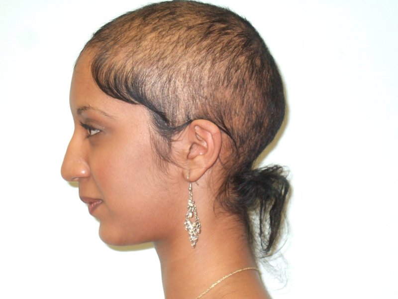regrowing hair from tension alopecia